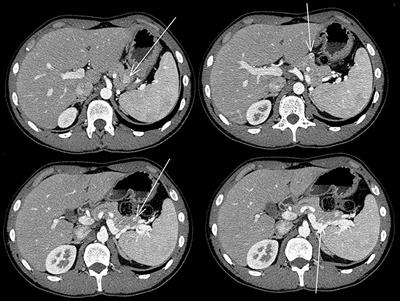 First Case of Mature Teratoma and Yolk Sac Testis Tumor Associated to Inherited MEN-1 Syndrome